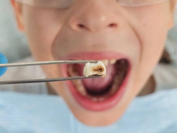 Best Emergency Dental Services for Seniors in Vevay, IN